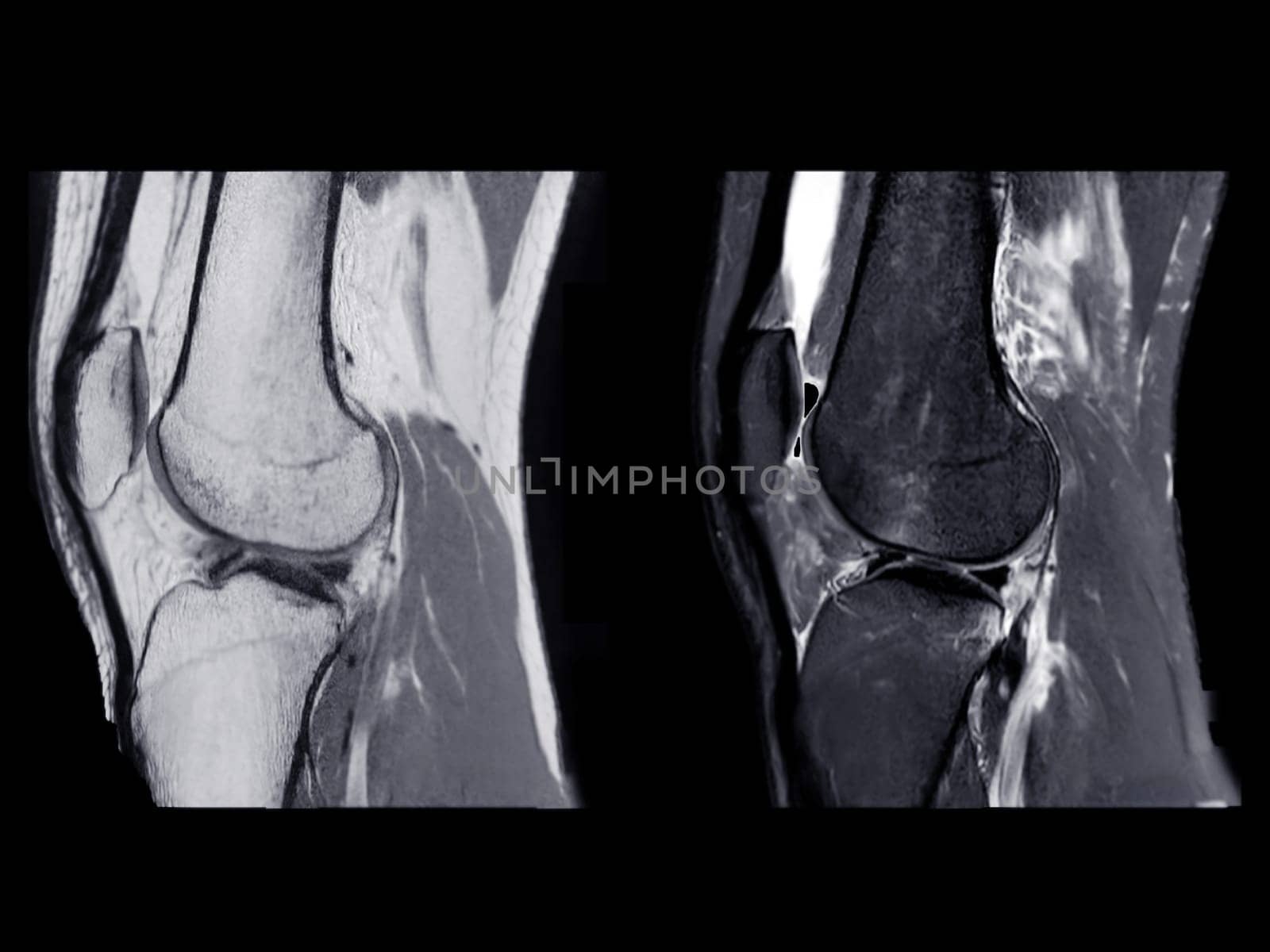 Magnetic resonance imaging or MRI of  knee joint Sagittal PDW and T2 FS for detect tear or sprain of the anterior cruciate  ligament (ACL) by samunella