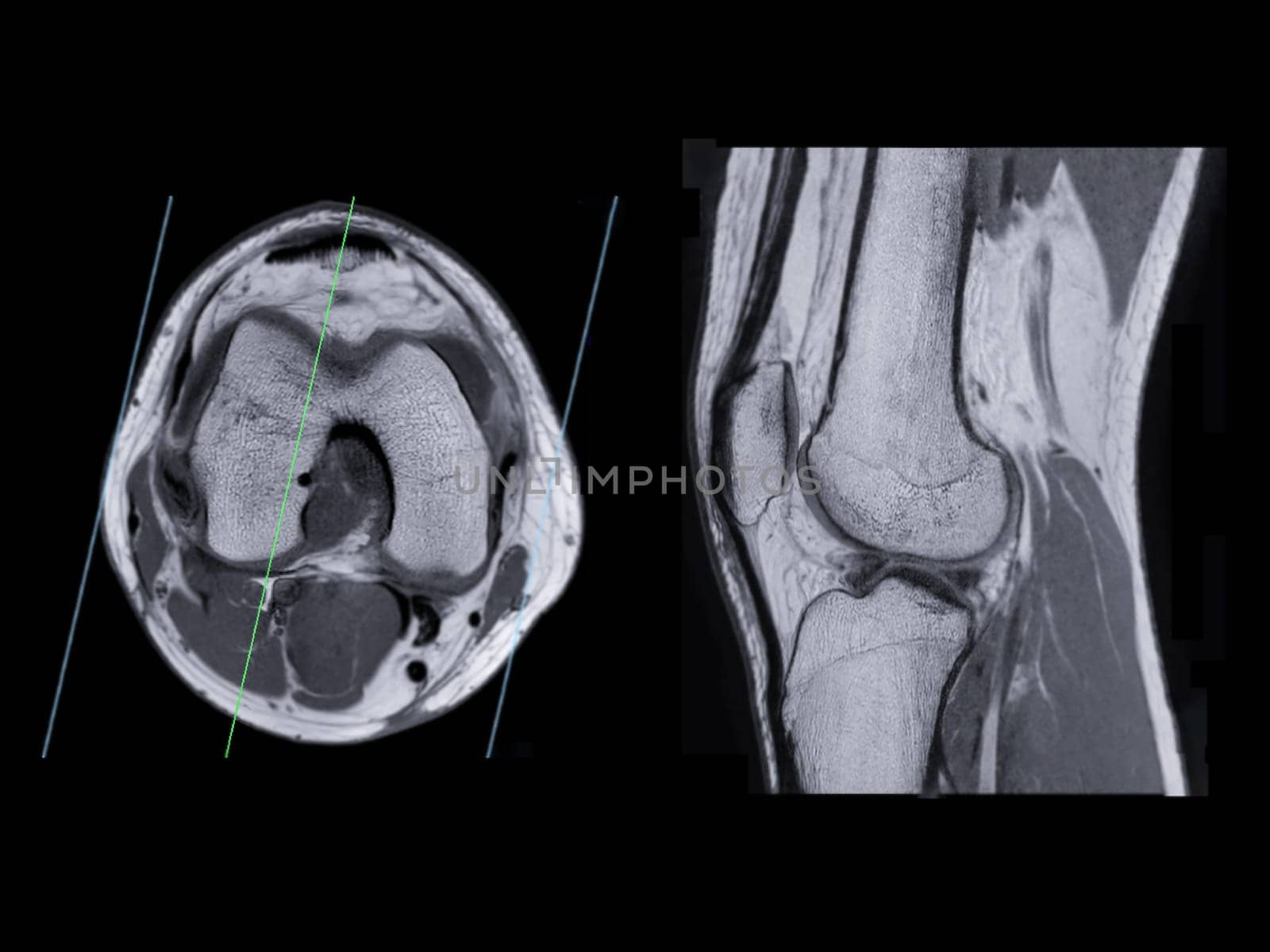 Magnetic resonance imaging or MRI of  knee joint Axial  and sagittal PDW  for detect tear or sprain of the anterior cruciate  ligament (ACL)