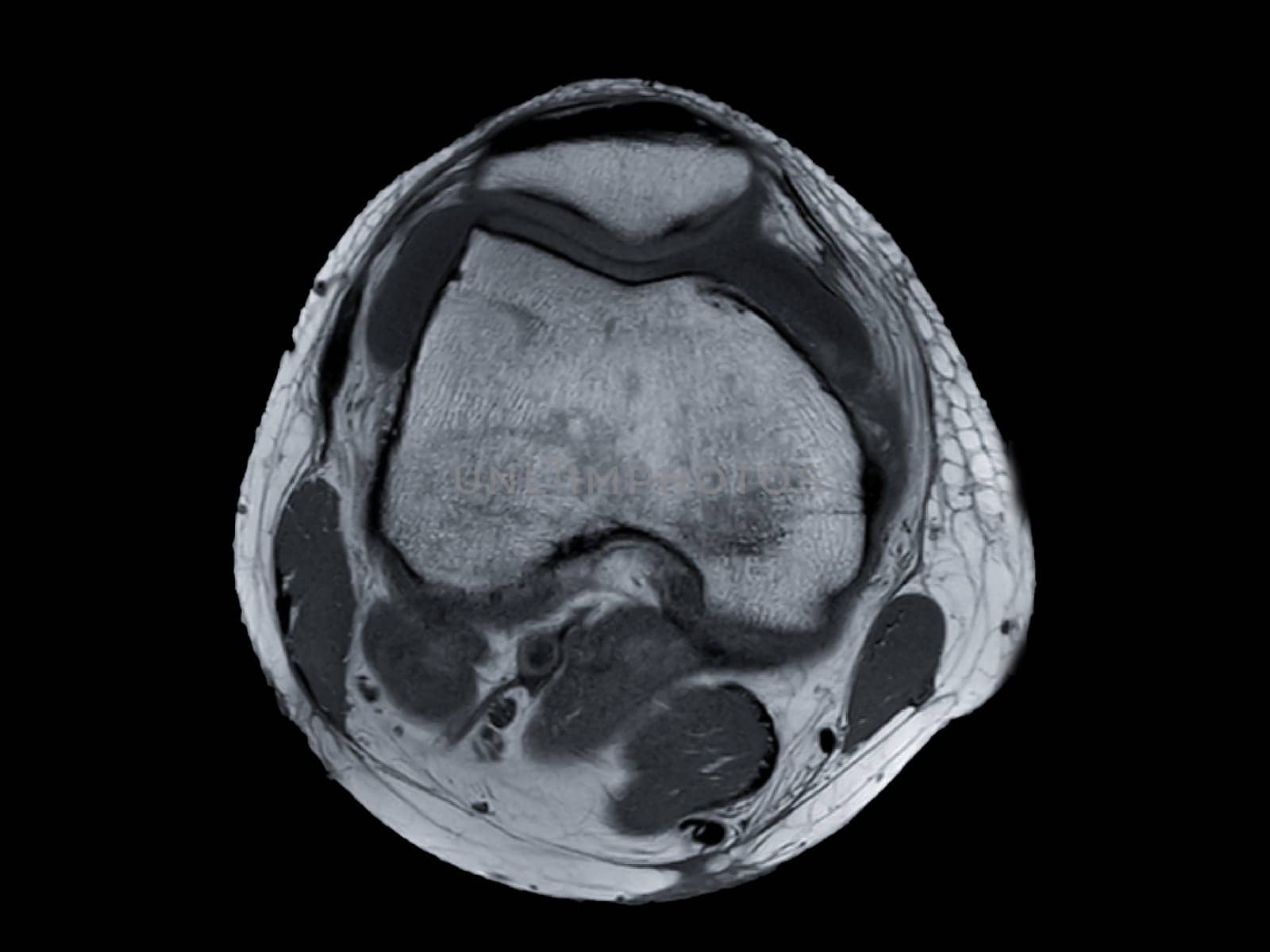 Magnetic resonance imaging or MRI of  knee joint Axial view for detect tear or sprain of the anterior cruciate  ligament (ACL)