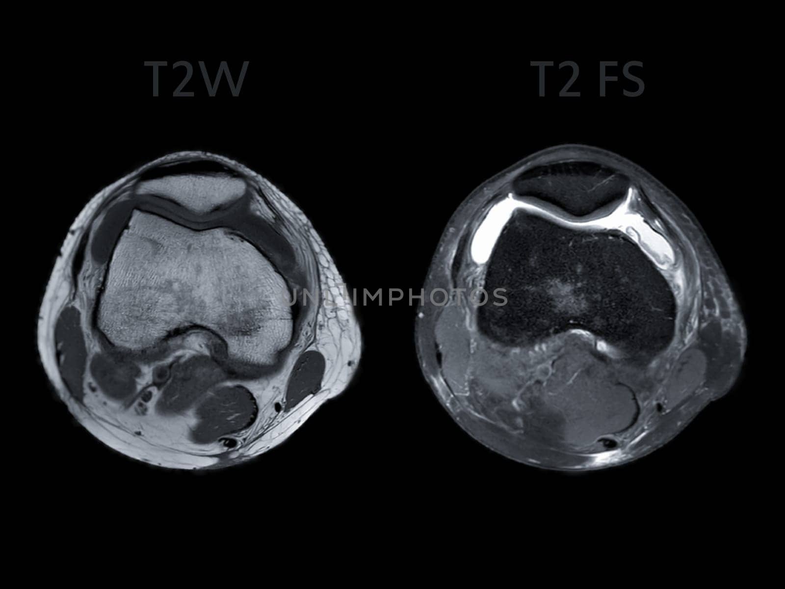 Magnetic resonance imaging or MRI of  knee joint Axial view T2 and T2 FS  for detect tear or sprain of the anterior cruciate  ligament (ACL) by samunella