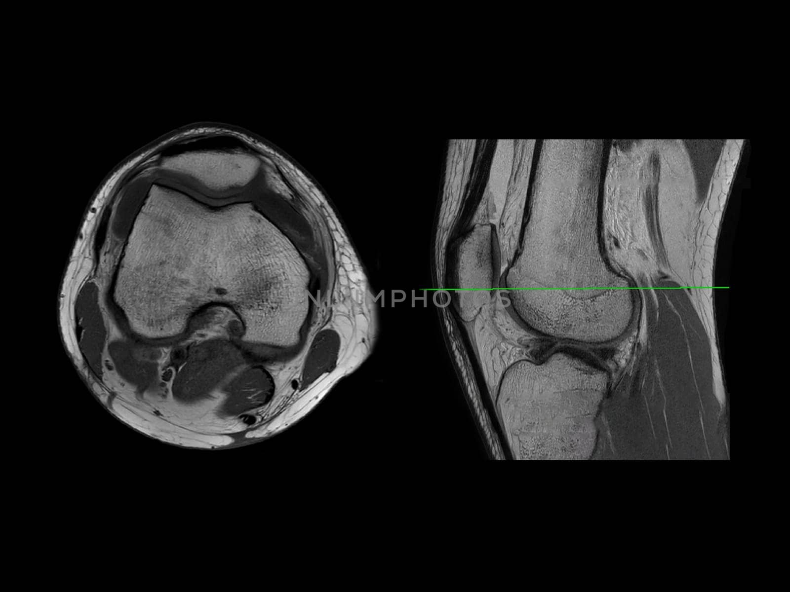 Magnetic resonance imaging or MRI of  knee joint Axial  and sagittal PDW  for detect tear or sprain of the anterior cruciate  ligament (ACL) by samunella