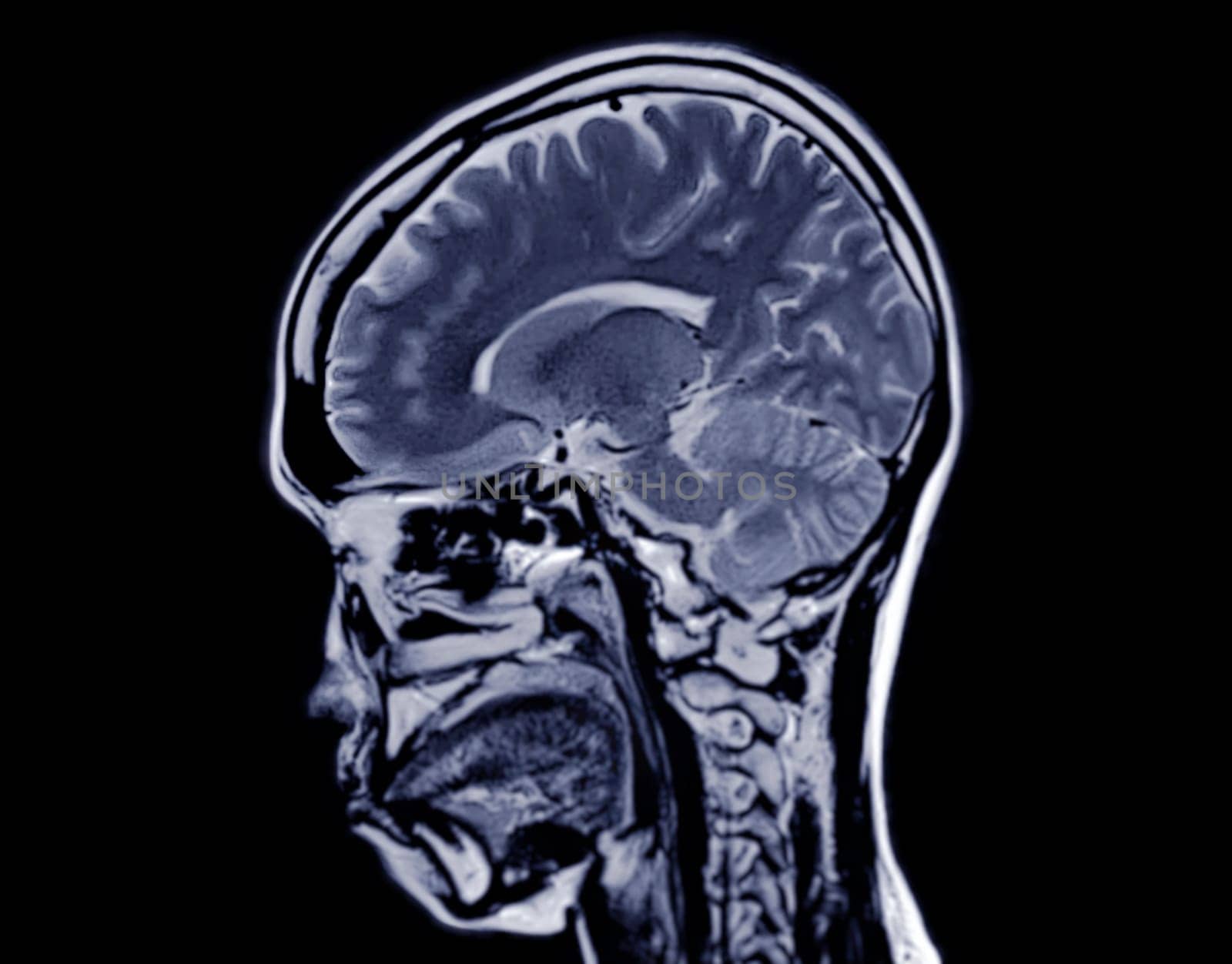 MRI  brain scan  sagittal plane for detect  Brain  diseases sush as stroke disease, Brain tumors and Infections. by samunella