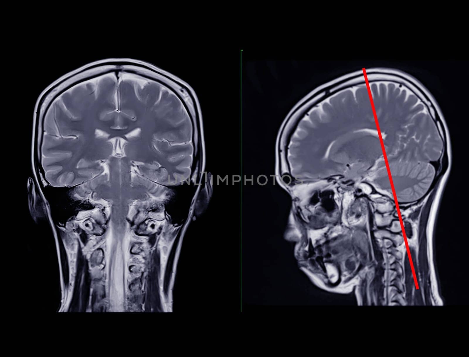 MRI  brain scan  Compare Coronal and sagittal plane for detect  Brain  diseases sush as stroke disease, Brain tumors and Infections.