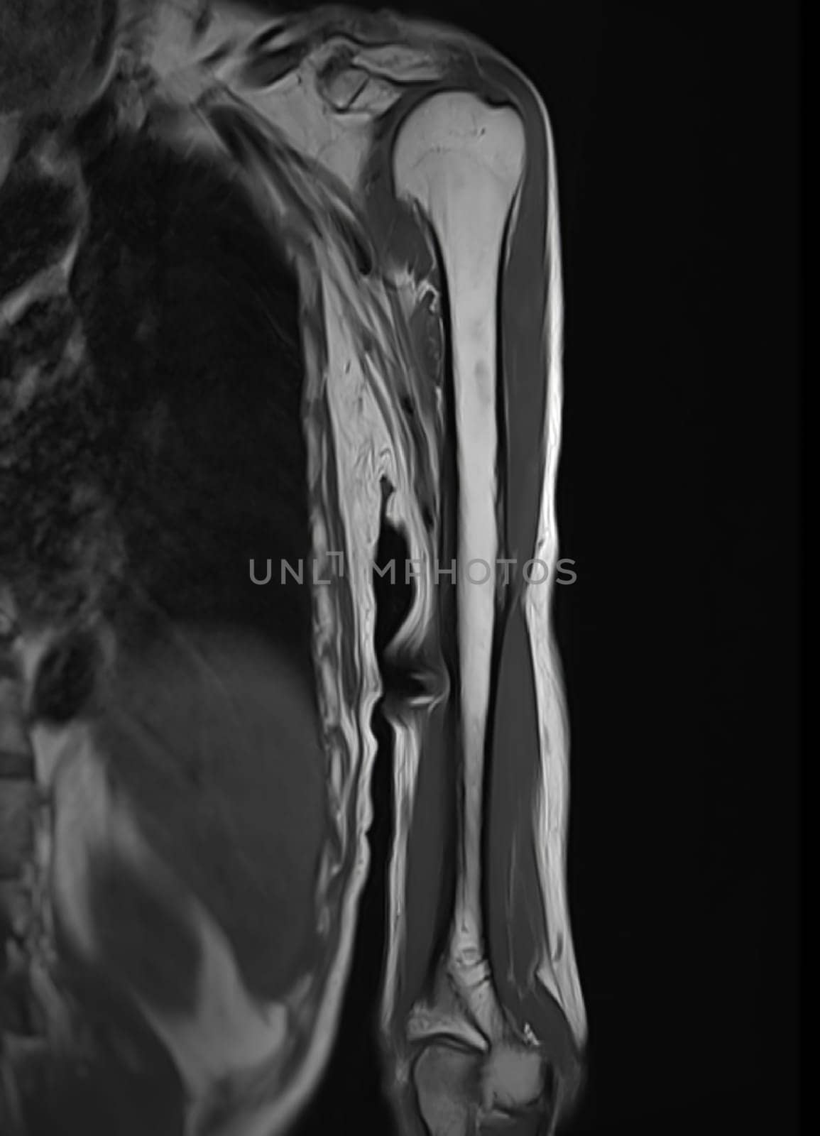 MRI Left humerus bone for diagnosis bone tumor.