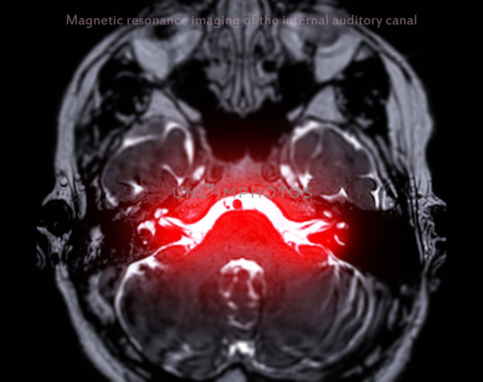 MRI Brain scan  with  the internal auditory canal (IAC) axial view.  by samunella