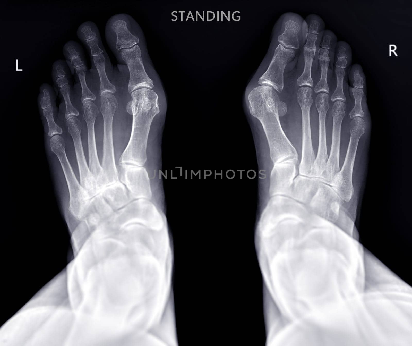 Foot x-ray image  AP  standing view  isolated on black background. by samunella