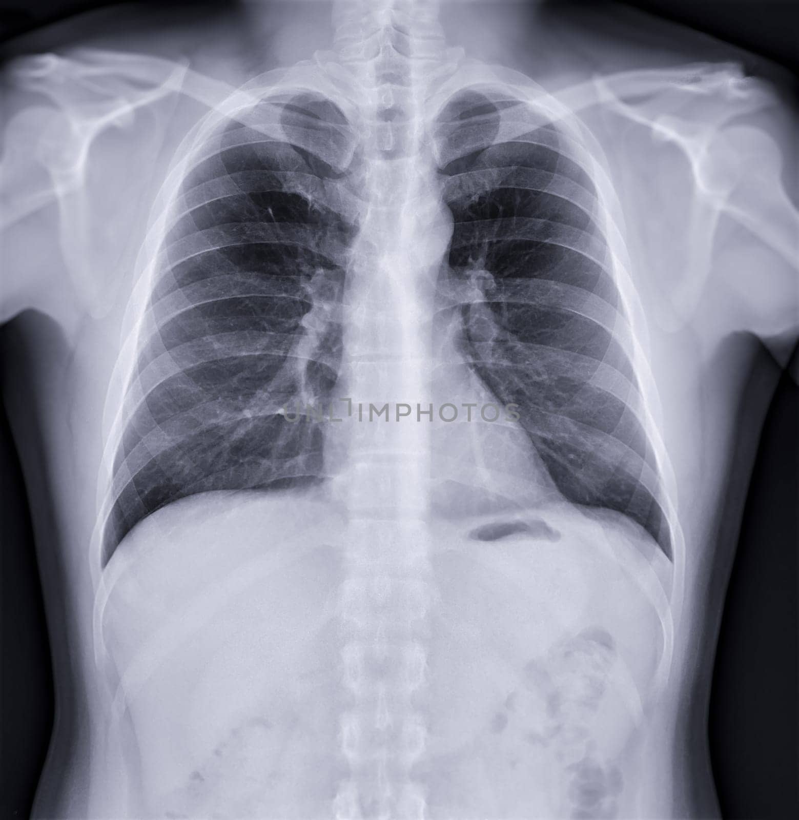 Chest x-ray image , Normal Chest.