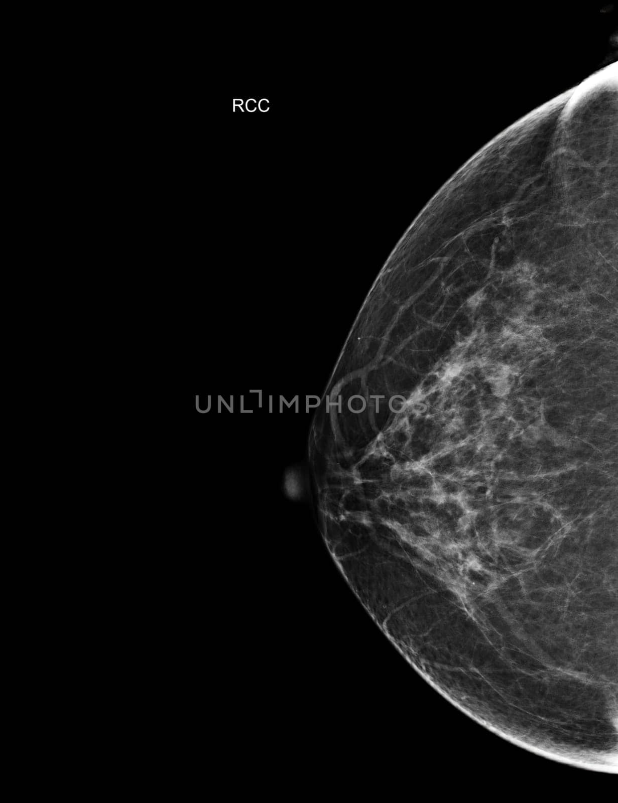  X-ray Digital Mammogram Right side  CC view . mammography or breast scan for Breast cancer  showing BI-RADS CATEGORY 2  Benign tumor.