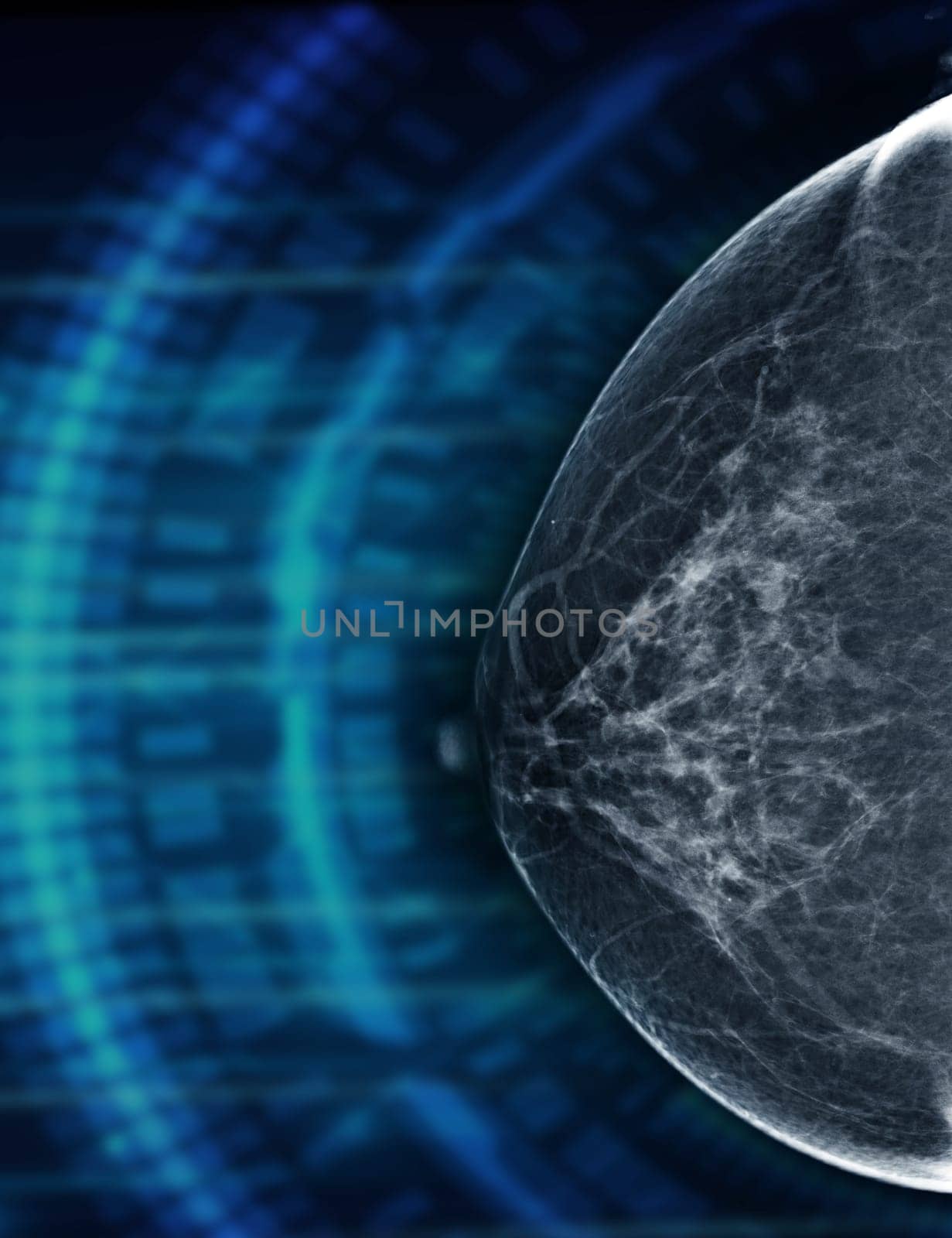  X-ray Digital Mammogram Right side  CC view BI -rads 2 .  by samunella