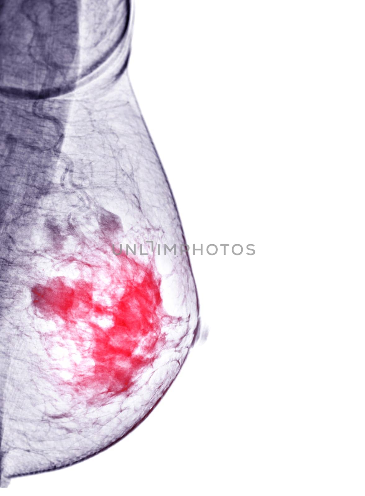 X-ray Digital Mammogram right side  MLO view . by samunella