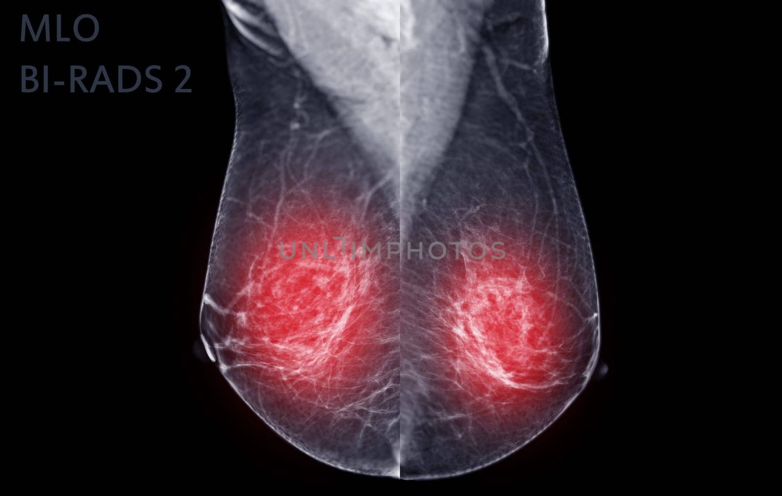 X-ray Digital Mammogram of Right  side  MLO view . mammography or breast scan for Breast cancer  showing BI-RADS CATEGORY 2  Benign tumor.