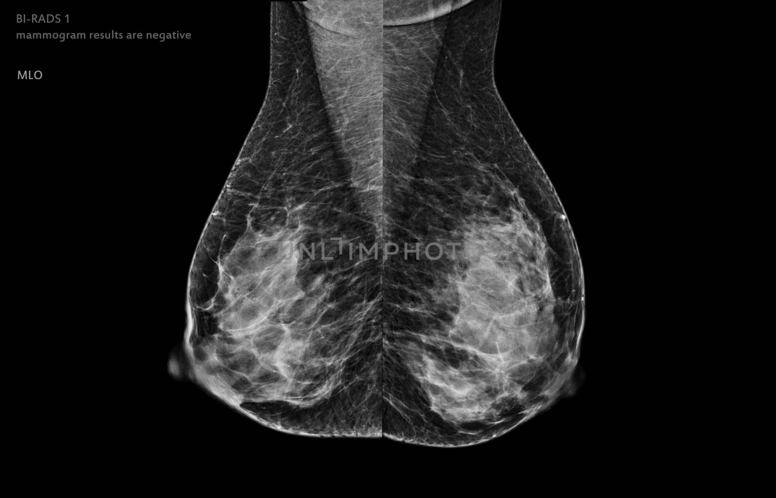  X-ray Digital Mammogram of both  side MLO view . mammography or breast scan for Breast cancer BI-RADS 1 mammogram results are negative.