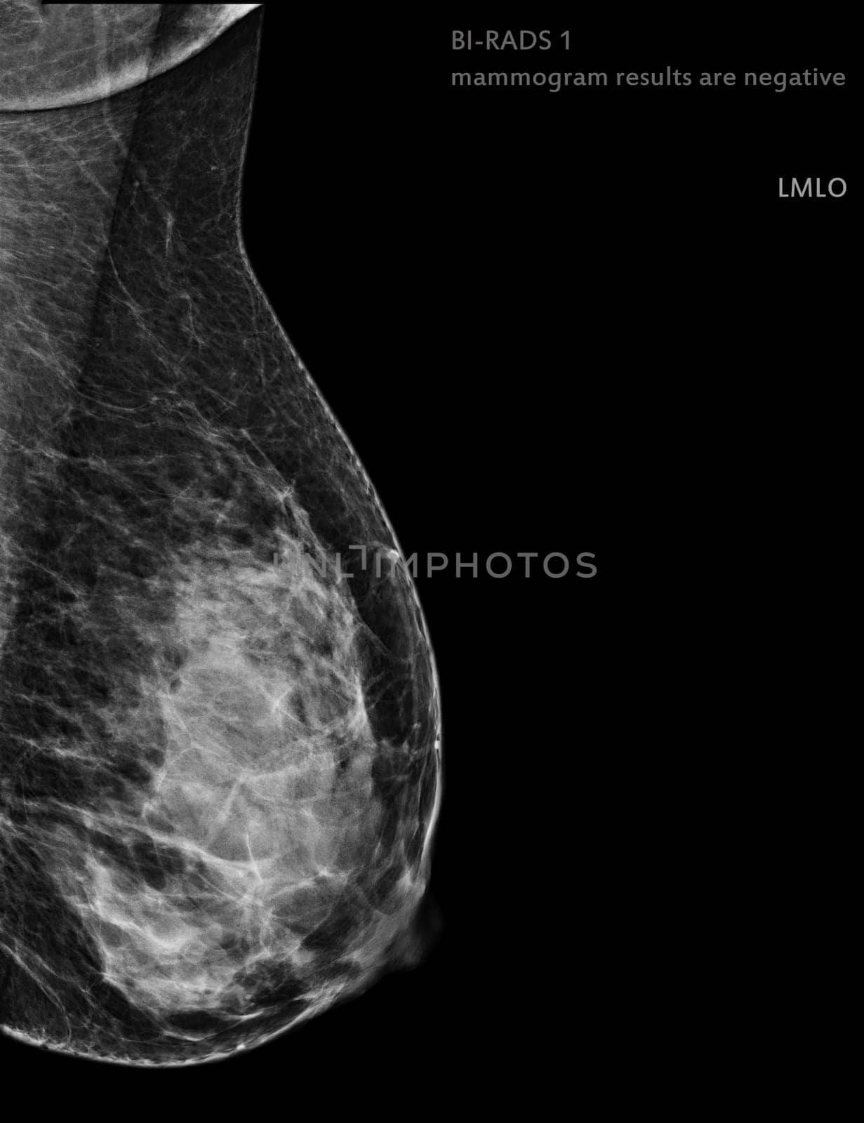  X-ray Digital Mammogram Right side MLO view . mammography or breast scan for Breast cancer BI-RADS 1 mammogram results are negative.
