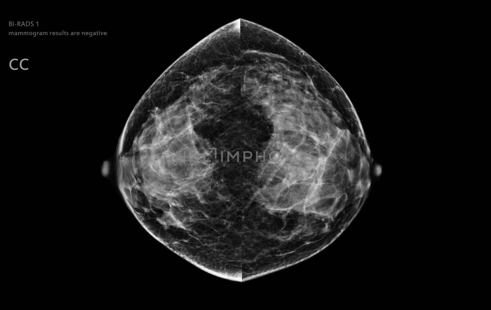  X-ray Digital Mammogram of both side CC view . mammography or breast scan for Breast cancer BI-RADS 1 mammogram results are negative.