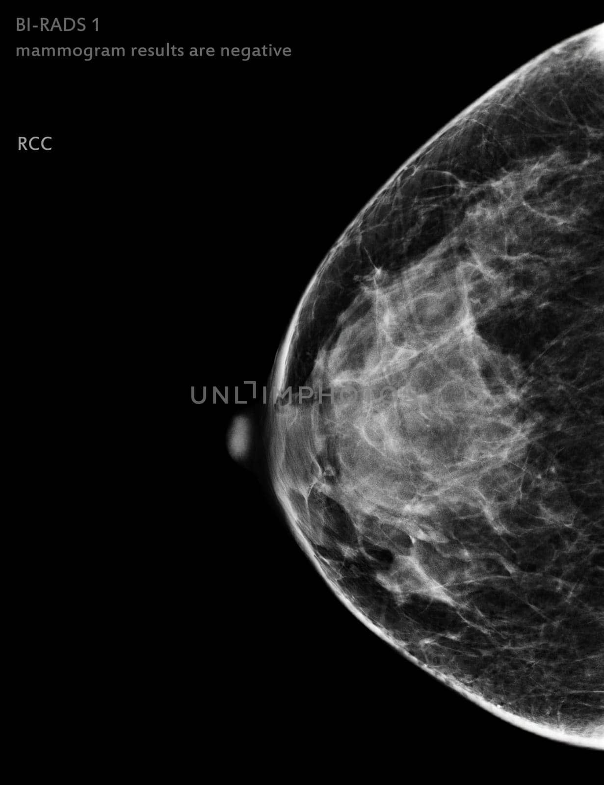  X-ray Digital Mammogram Right side CC view . mammography or breast scan for Breast cancer BI-RADS 1 mammogram results are negative.