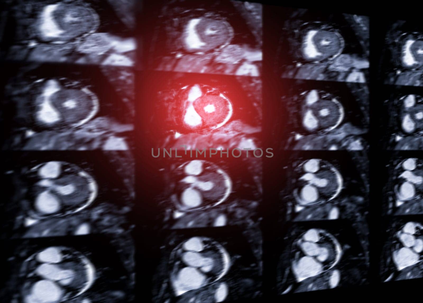 MRI heart or Cardiac MRI ( magnetic resonance imaging ) of heart for diagnosis heart disease.