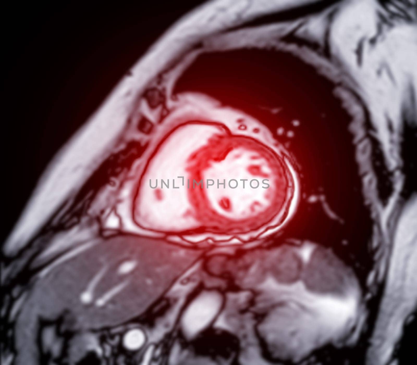 MRI heart or Cardiac MRI ( magnetic resonance imaging ) of heart for diagnosis heart disease.