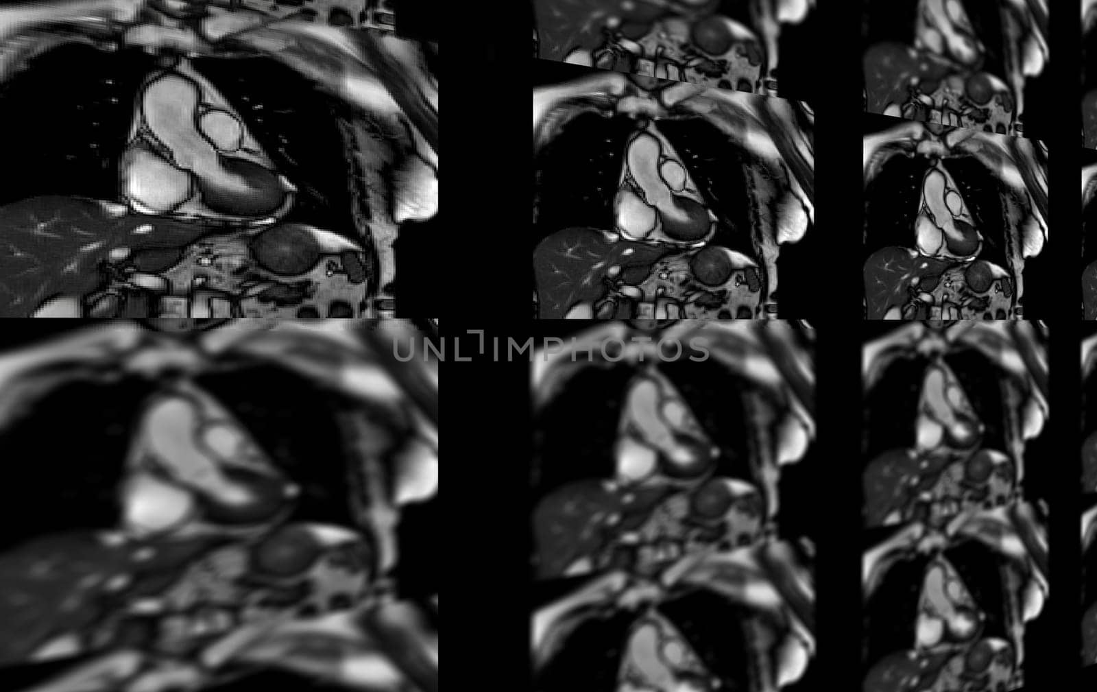 MRI heart or Cardiac MRI ( magnetic resonance imaging ) of heart for diagnosis heart disease.