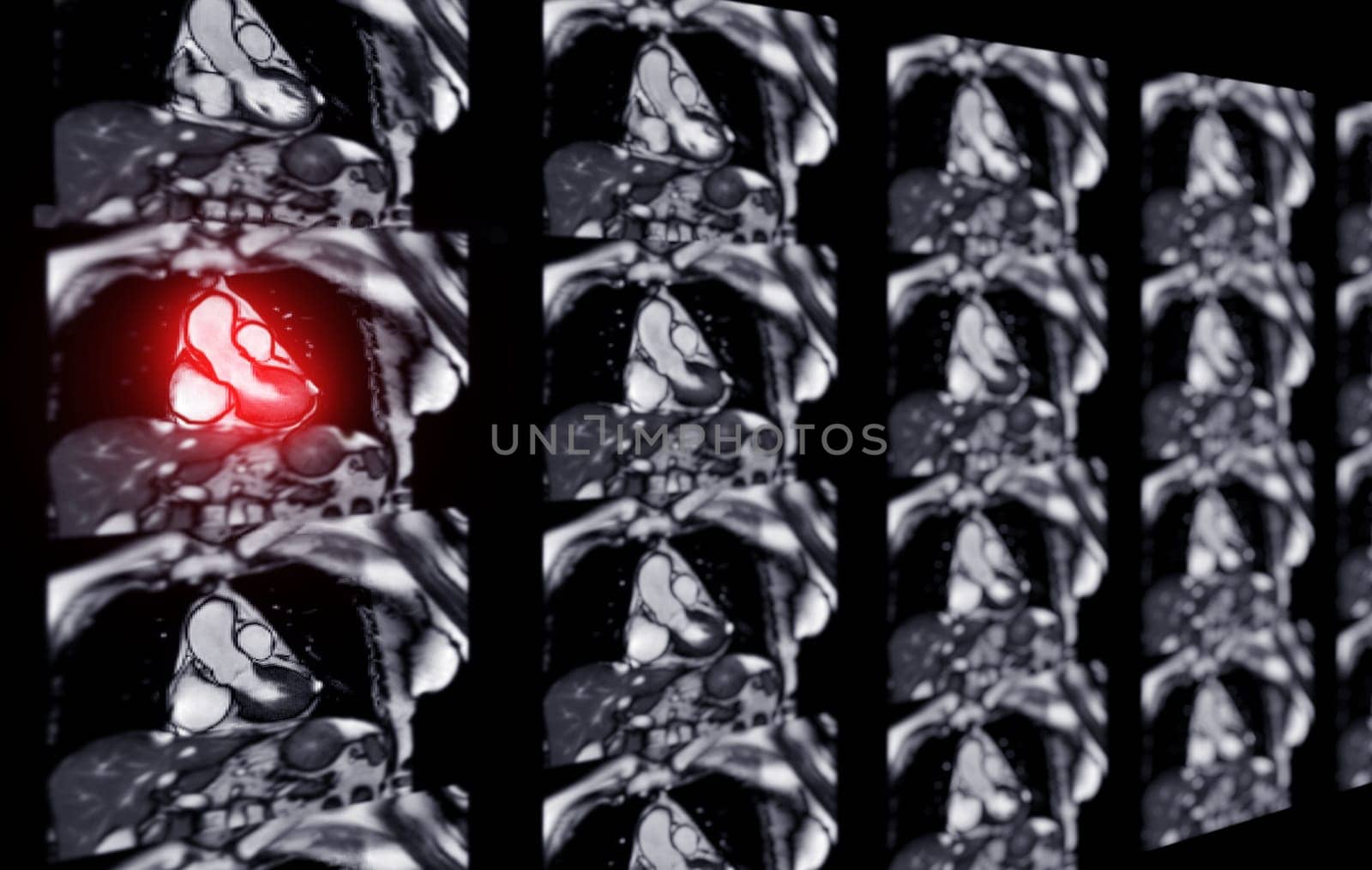 MRI heart or Cardiac MRI ( magnetic resonance imaging ) of heart for diagnosis heart disease. by samunella