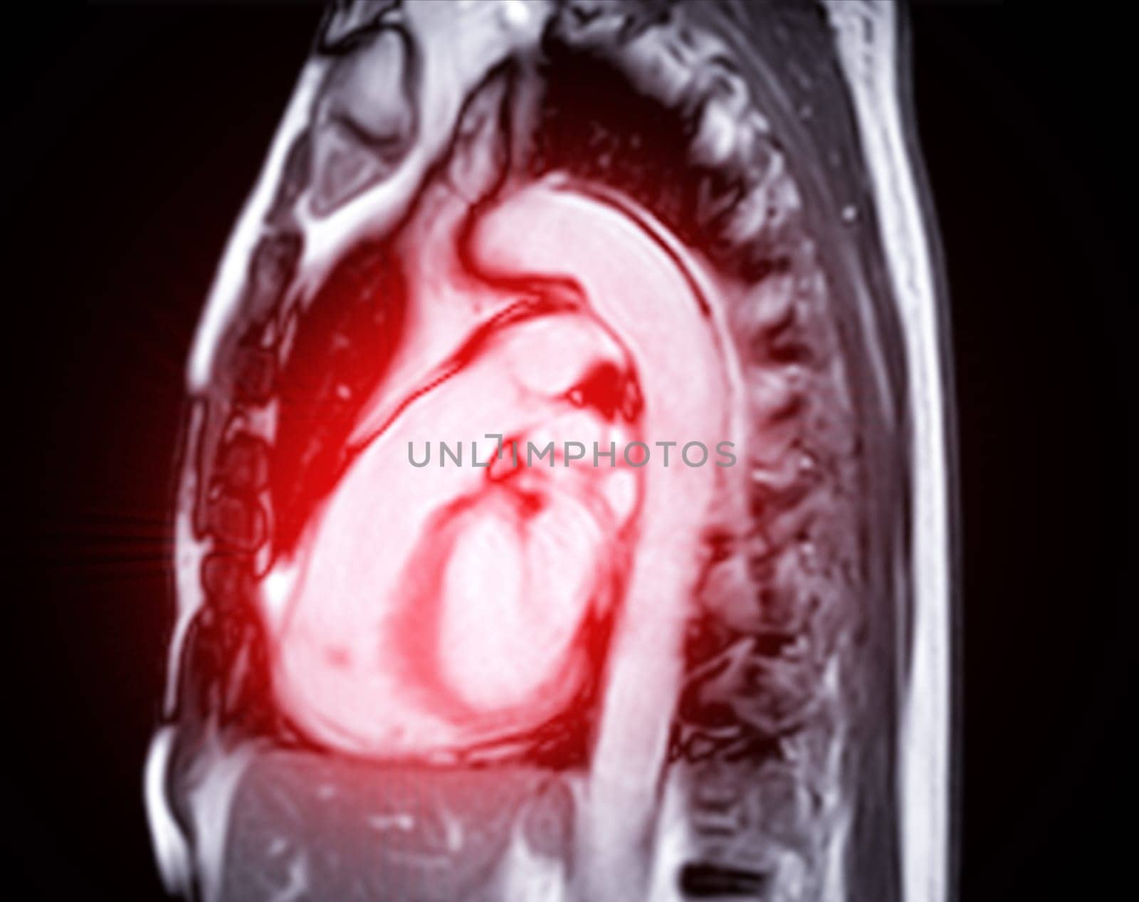 MRI heart or Cardiac MRI ( magnetic resonance imaging ) of heart for diagnosis heart disease.