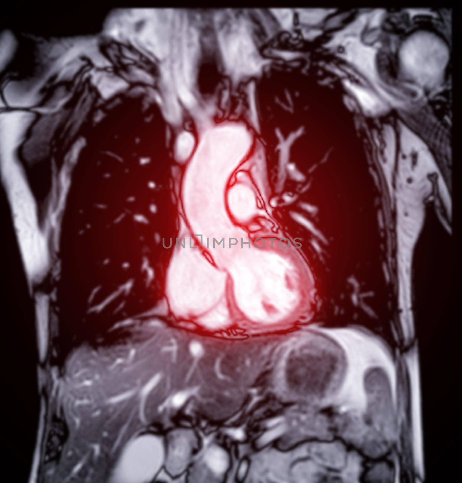 MRI heart or Cardiac MRI ( magnetic resonance imaging ) of heart for diagnosis heart disease. by samunella