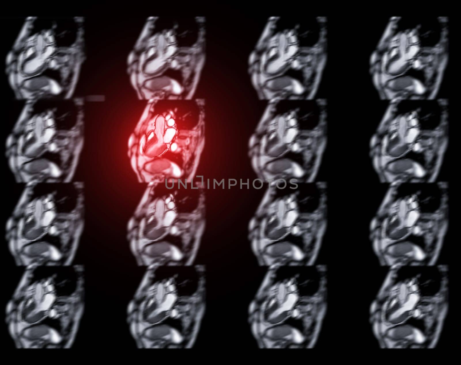 MRI heart or Cardiac MRI ( magnetic resonance imaging ) of heart for diagnosis heart disease. by samunella