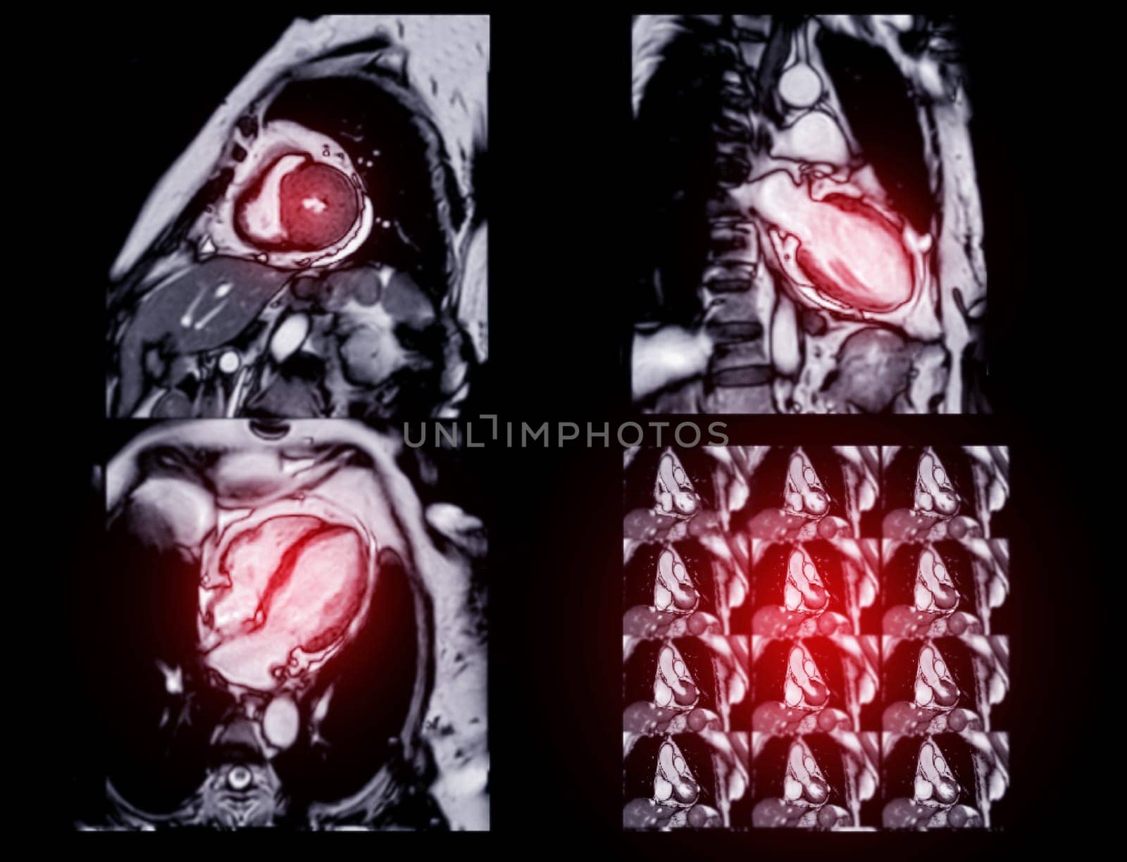 MRI heart or Cardiac MRI ( magnetic resonance imaging ) of heart for diagnosis heart disease. by samunella