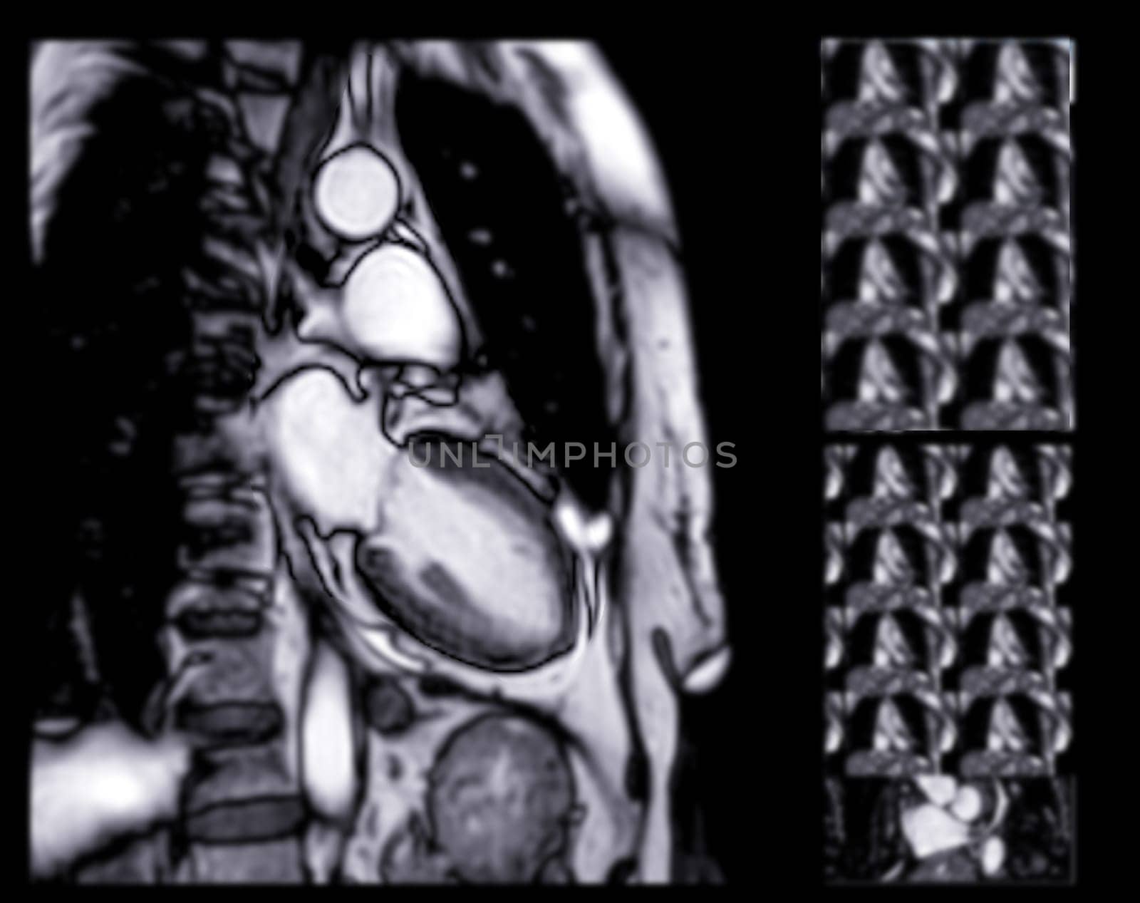 MRI heart or Cardiac MRI ( magnetic resonance imaging ) of heart for diagnosis heart disease. by samunella