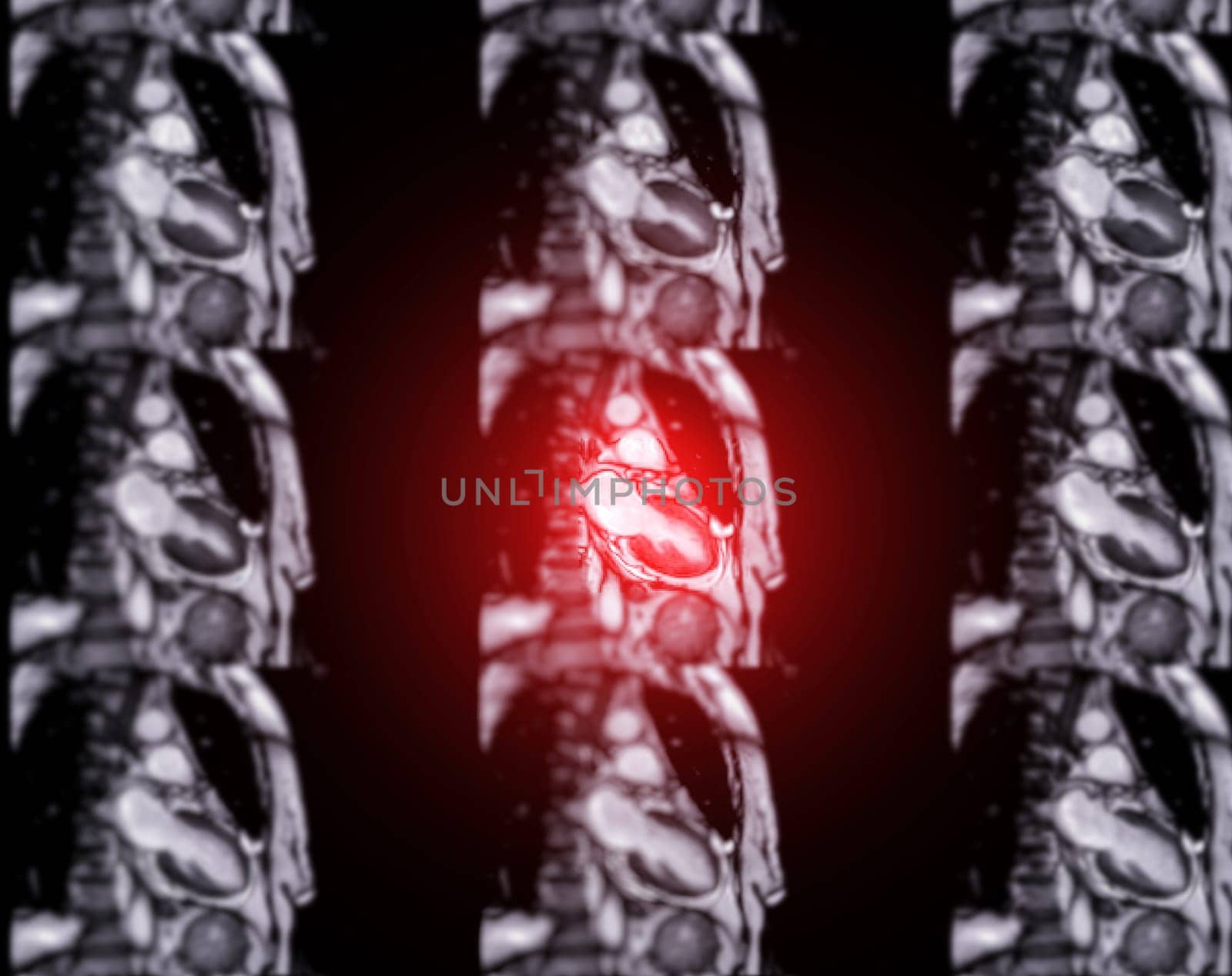 MRI heart or Cardiac MRI ( magnetic resonance imaging ) of heart for diagnosis heart disease. by samunella