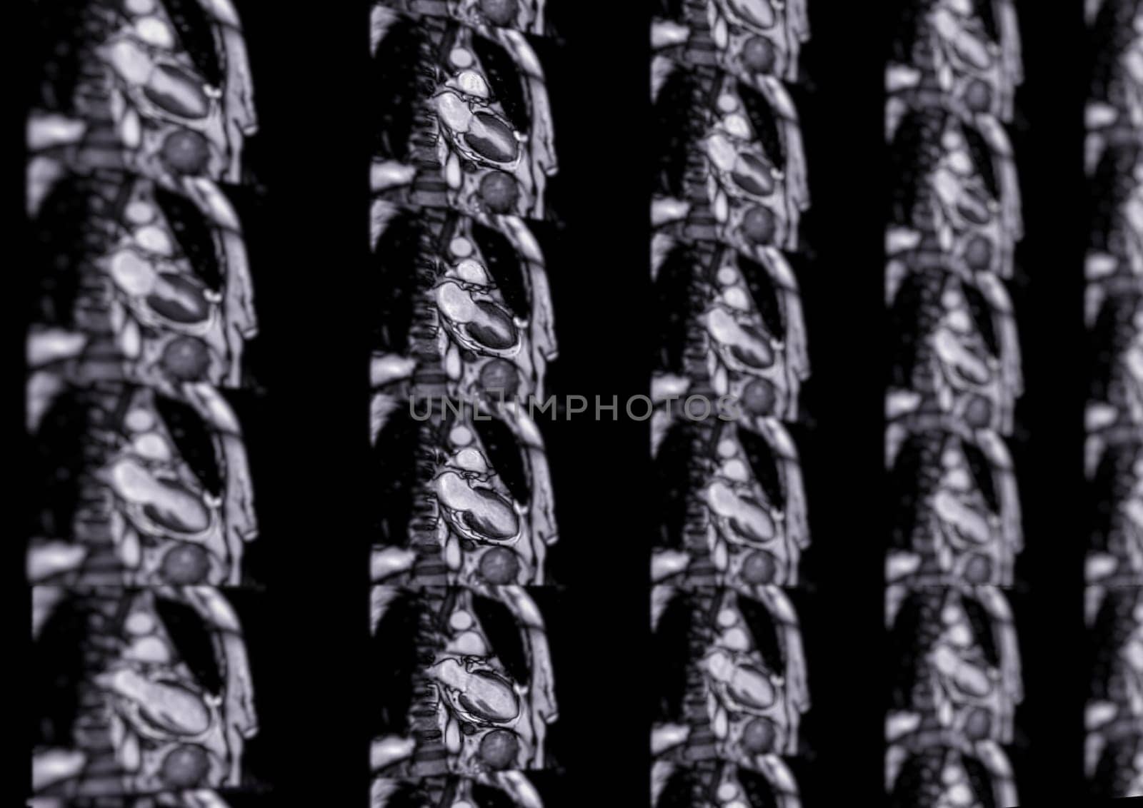 MRI heart or Cardiac MRI ( magnetic resonance imaging ) of heart for diagnosis heart disease.