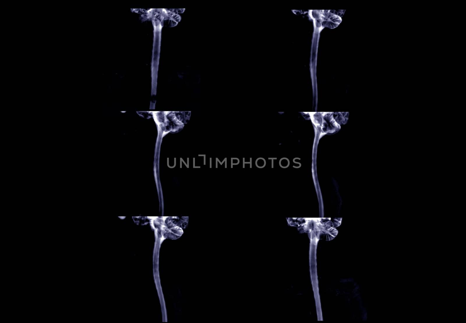 MRI of  C-spine or magnetic resonance image of cervical spine sagittal view  for diagnosis spondylosis causing cervical spondylotic myelopathy and compression fracture. by samunella