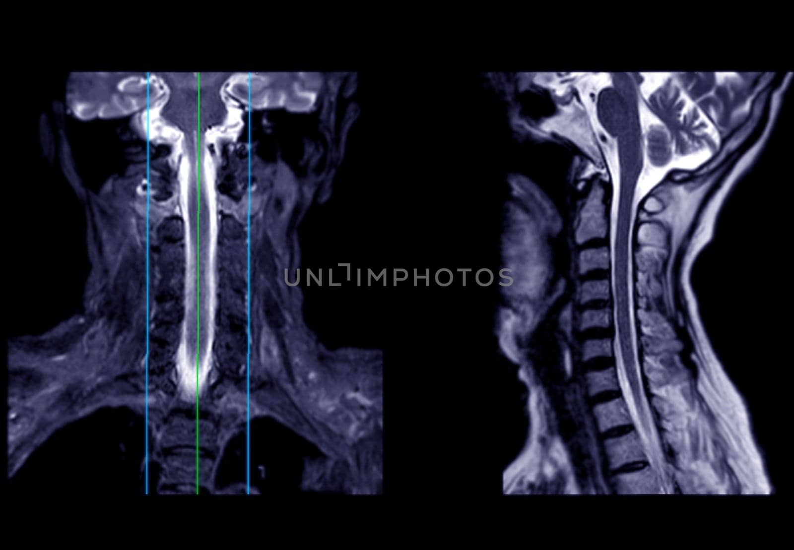 MRI of  C-spine or magnetic resonance image of cervical spine sagittal view  for diagnosis spondylosis causing cervical spondylotic myelopathy and compression fracture. by samunella