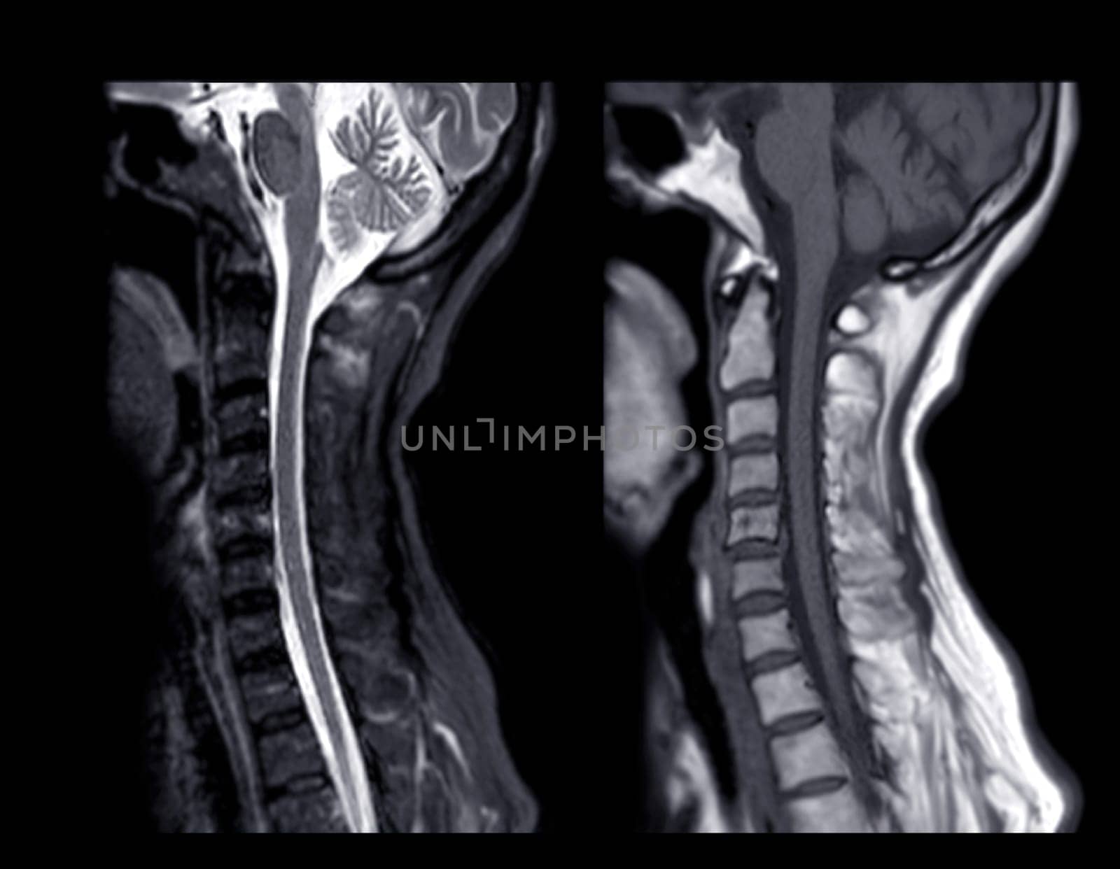 MRI of  C-spine or magnetic resonance image of cervical spine sagittal view  for diagnosis spondylosis causing cervical spondylotic myelopathy and compression fracture.