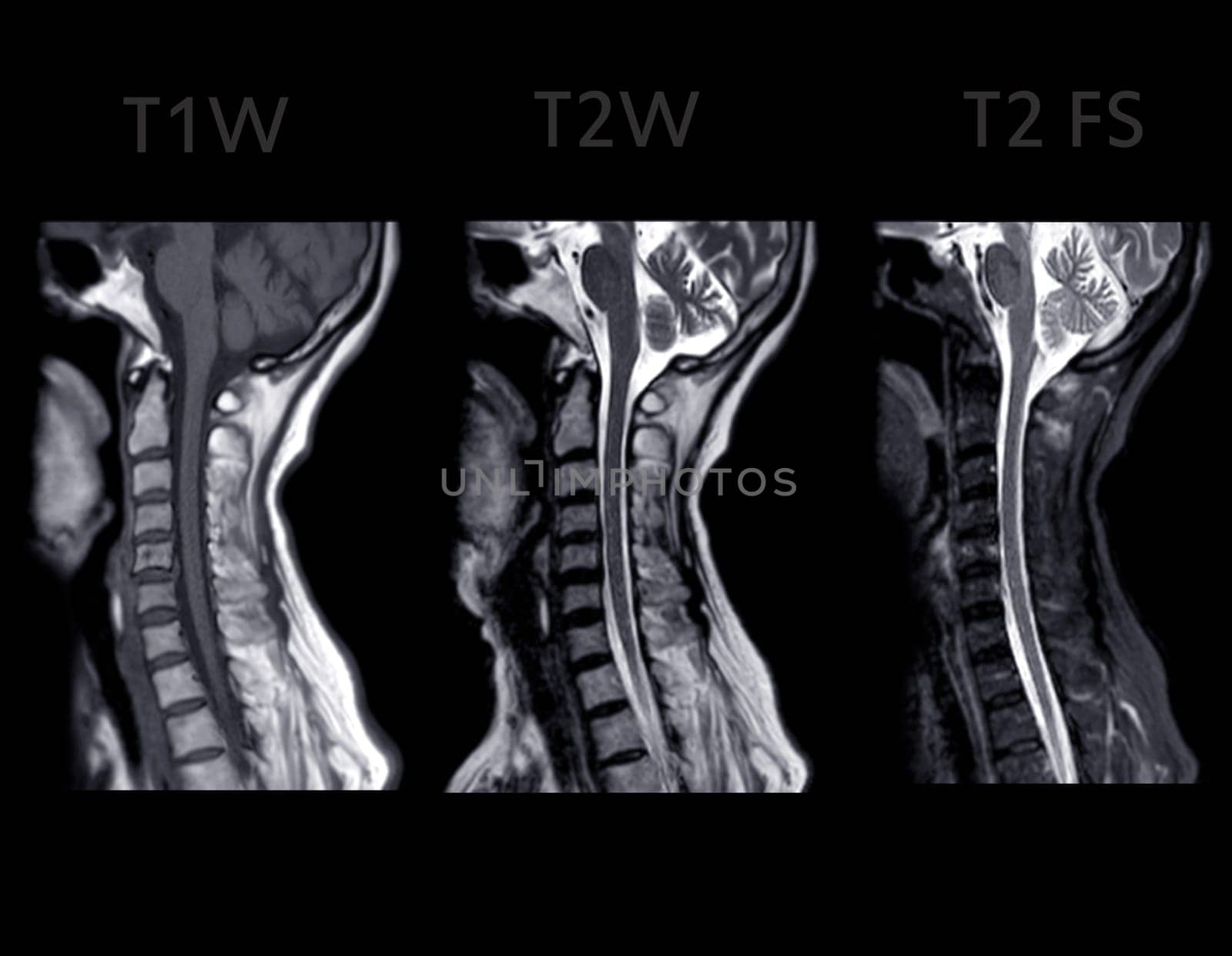 MRI of  C-spine or magnetic resonance image of cervical spine sagittal view  for diagnosis spondylosis causing cervical spondylotic myelopathy and compression fracture. by samunella