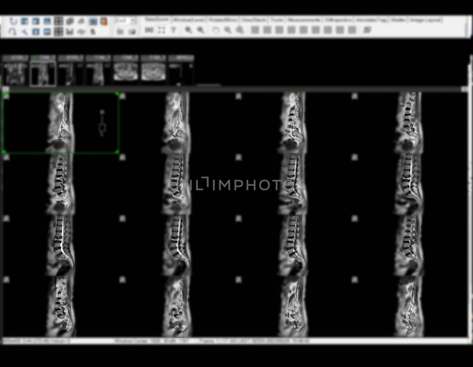 MRI L-S spine or lumbar spine sagittal view for diagnosis spinal cord compression.