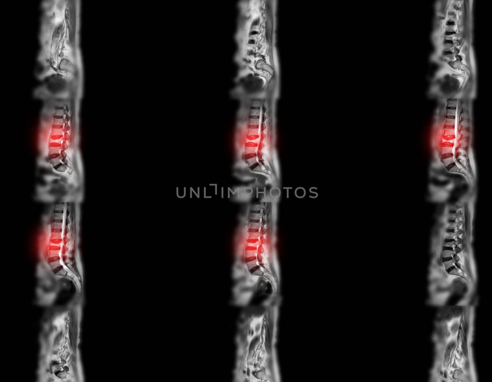 MRI L-S spine or lumbar spine for diagnosis spinal cord compression. by samunella