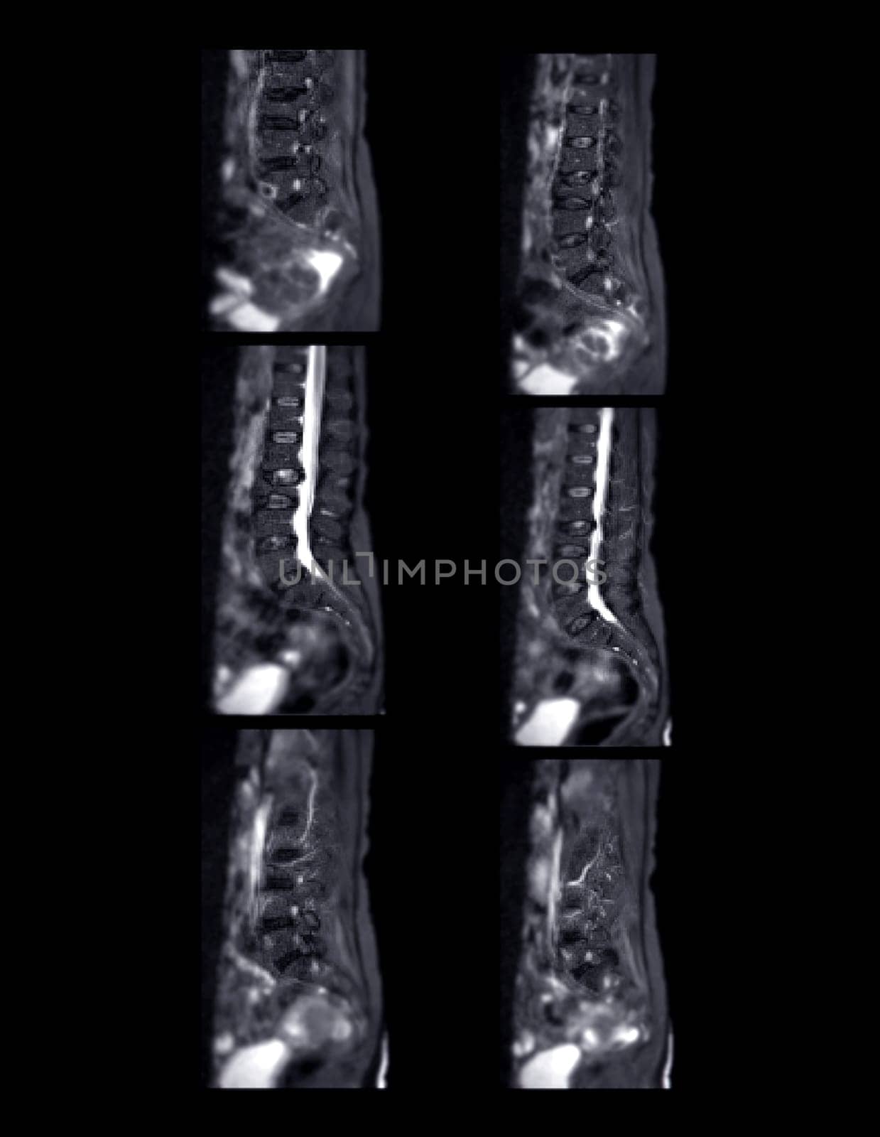 MRI L-S spine or lumbar spine for diagnosis spinal cord compression. by samunella