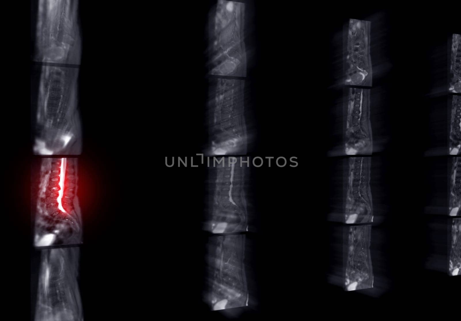 MRI L-S spine or lumbar spine for diagnosis spinal cord compression.