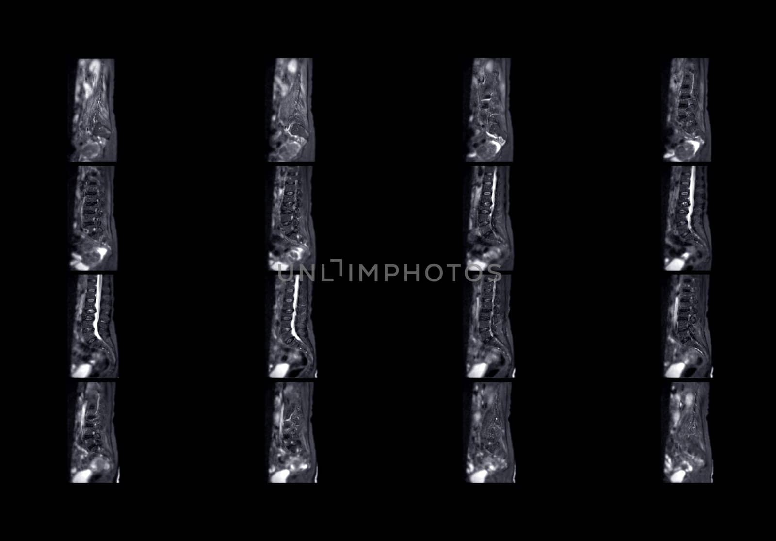 MRI L-S spine or lumbar spine for diagnosis spinal cord compression. by samunella