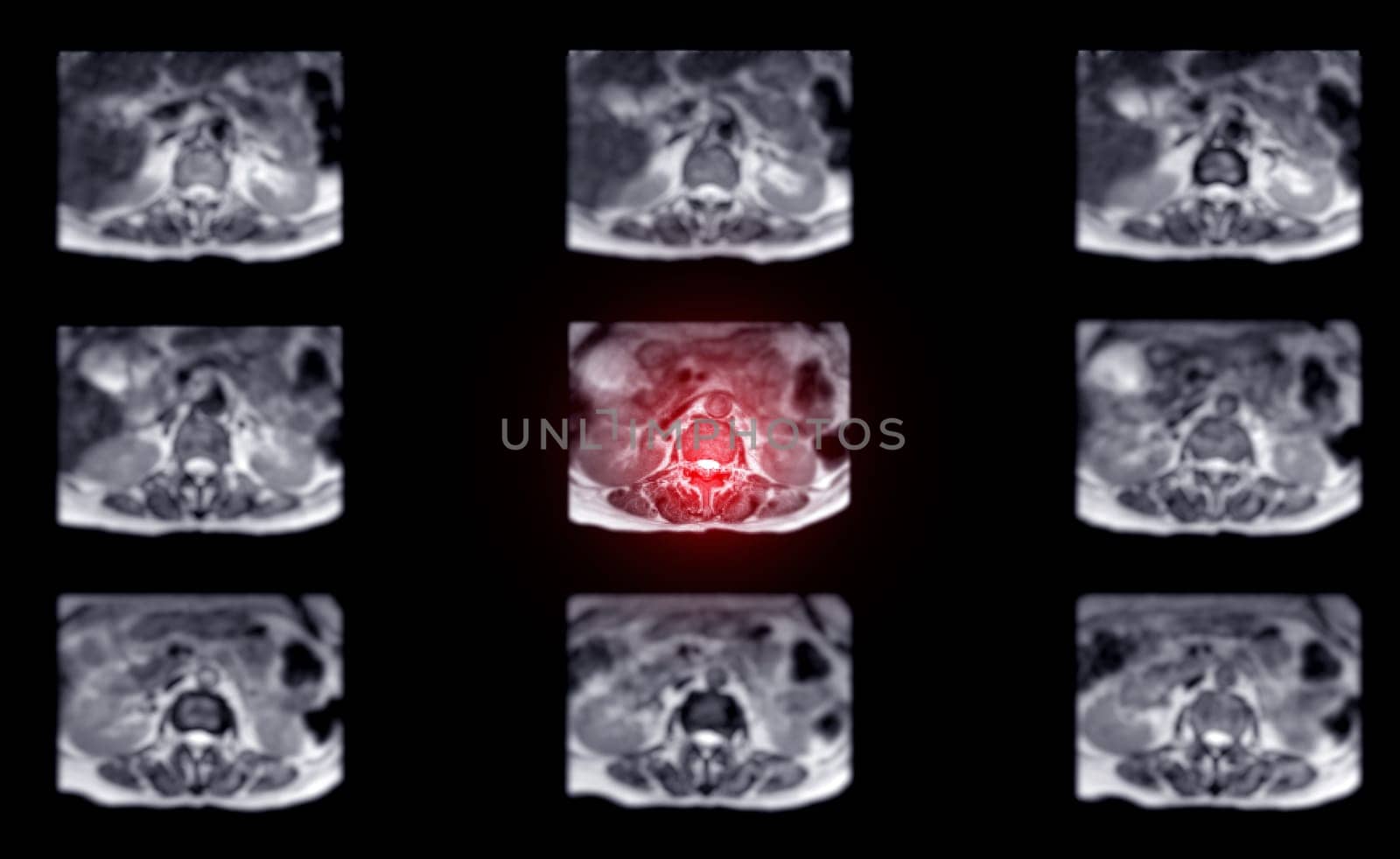 MRI L-S spine or lumbar spine for diagnosis spinal cord compression. by samunella