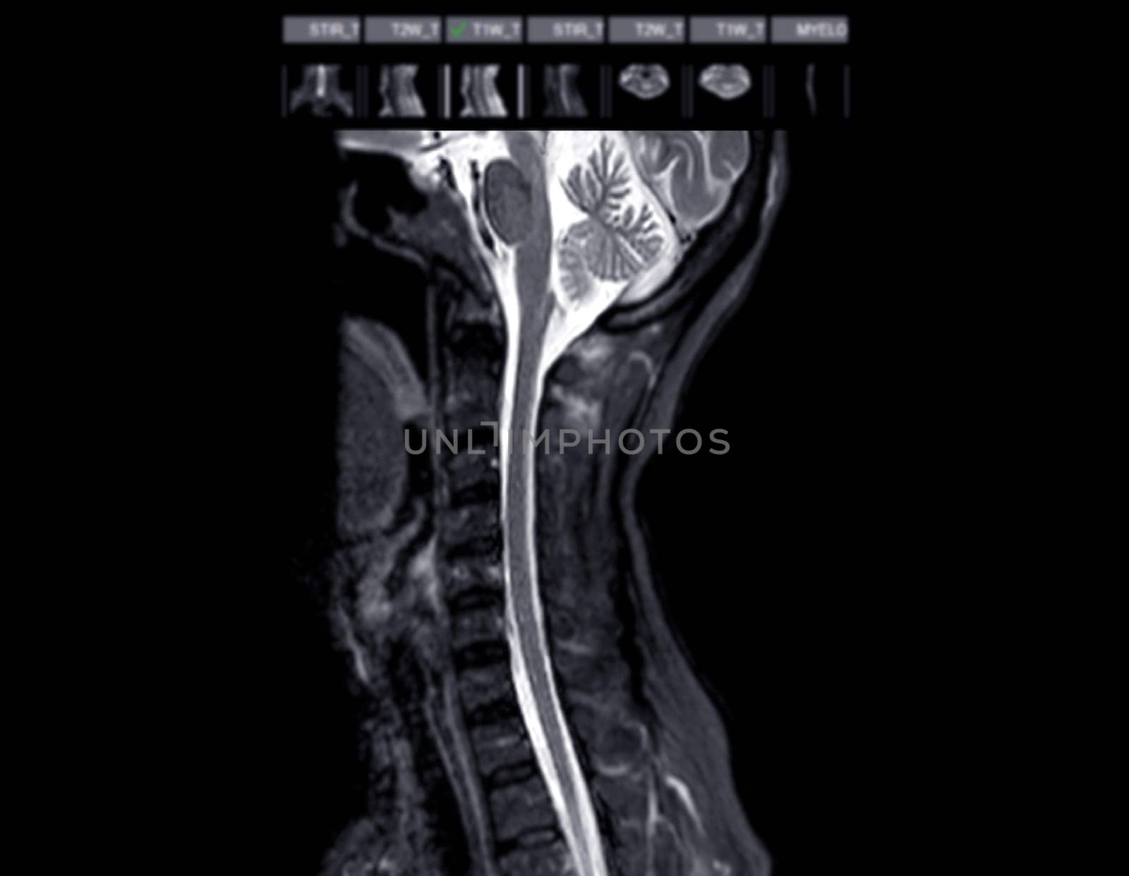 MRI of C-spine or magnetic resonance image of cervical spine sagittal view for diagnosis spondylosis causing cervical spondylotic myelopathy and compression fracture. by samunella