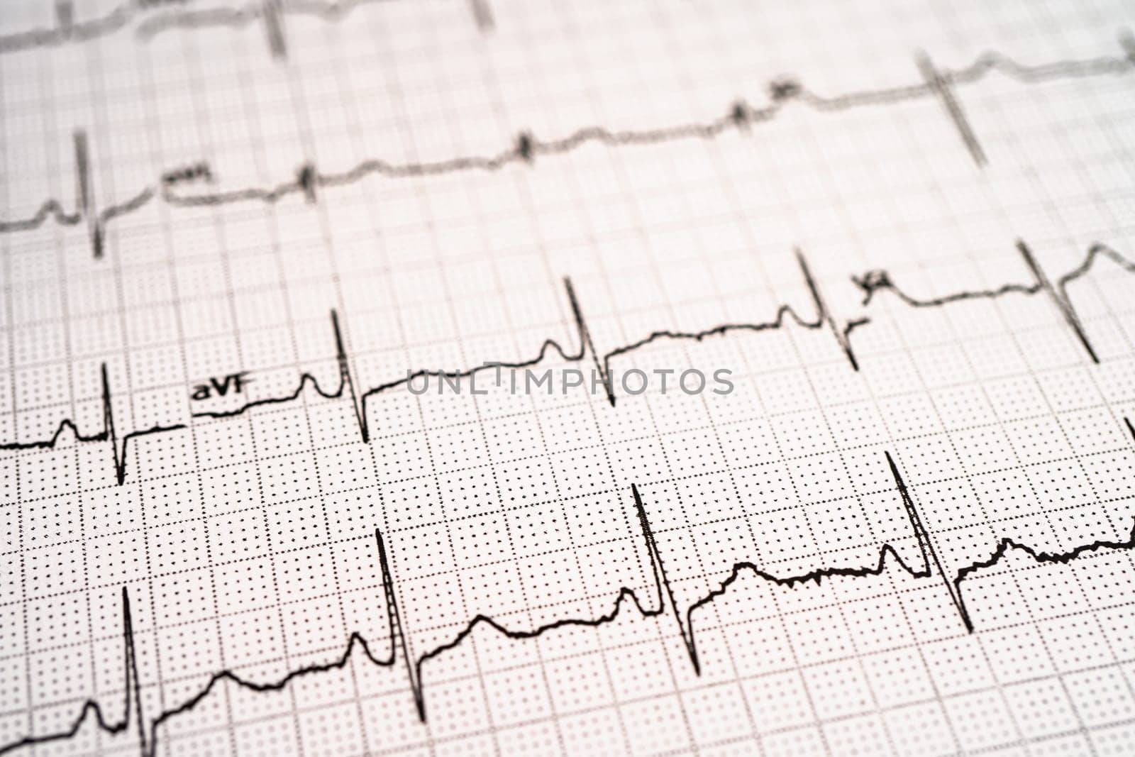 Electrocardiogram ECG, heart wave, heart attack, cardiogram report. by pamai