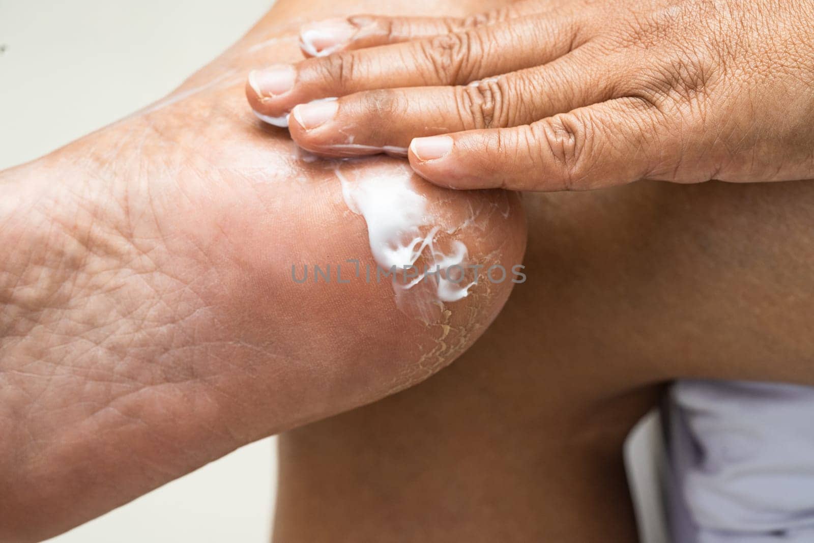 Woman care feet with cracked and dry heel skin cream at home.