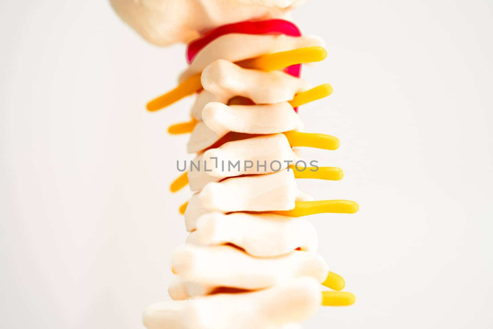 Lumbar spine displaced herniated disc fragment, spinal nerve and bone. Model on white background with clipping path, for treatment medical in the orthopedic department.