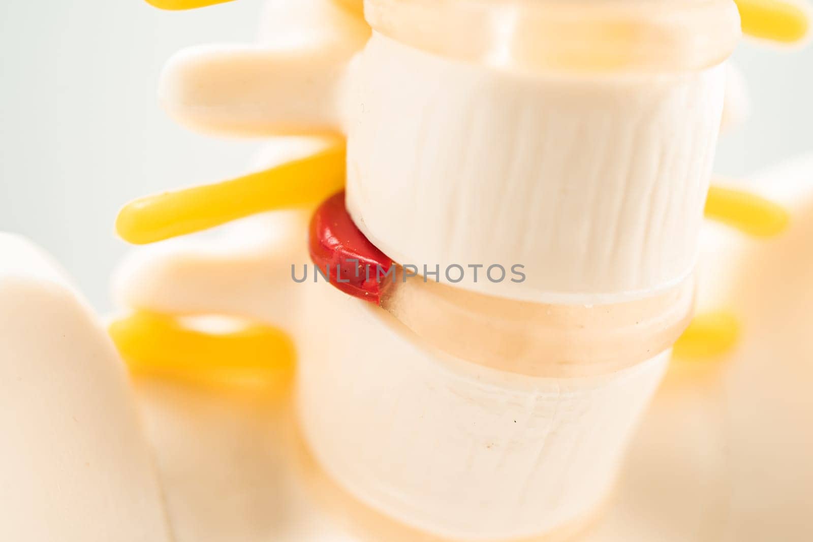 Lumbar spine displaced herniated disc fragment, spinal nerve and bone. Model for treatment medical in the orthopedic department.