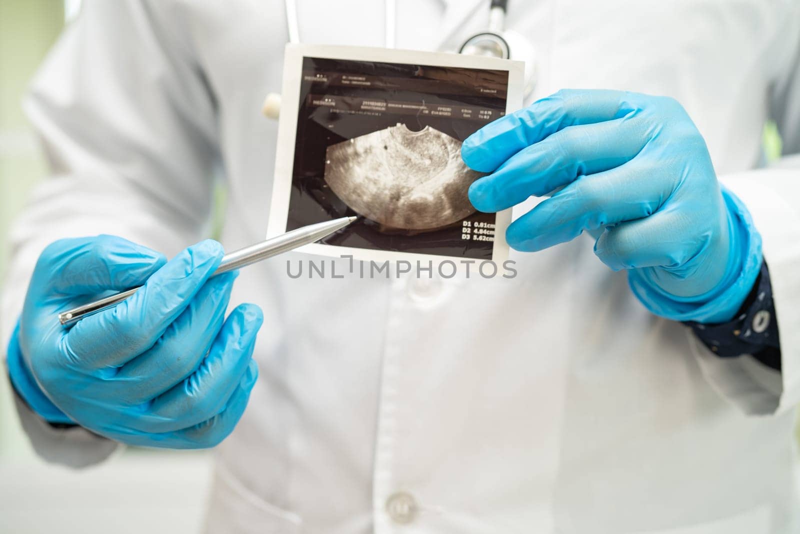 Uterus and ovary, doctor holding anatomy model and ultrasound picture for study diagnosis and treatment in hospital. by pamai