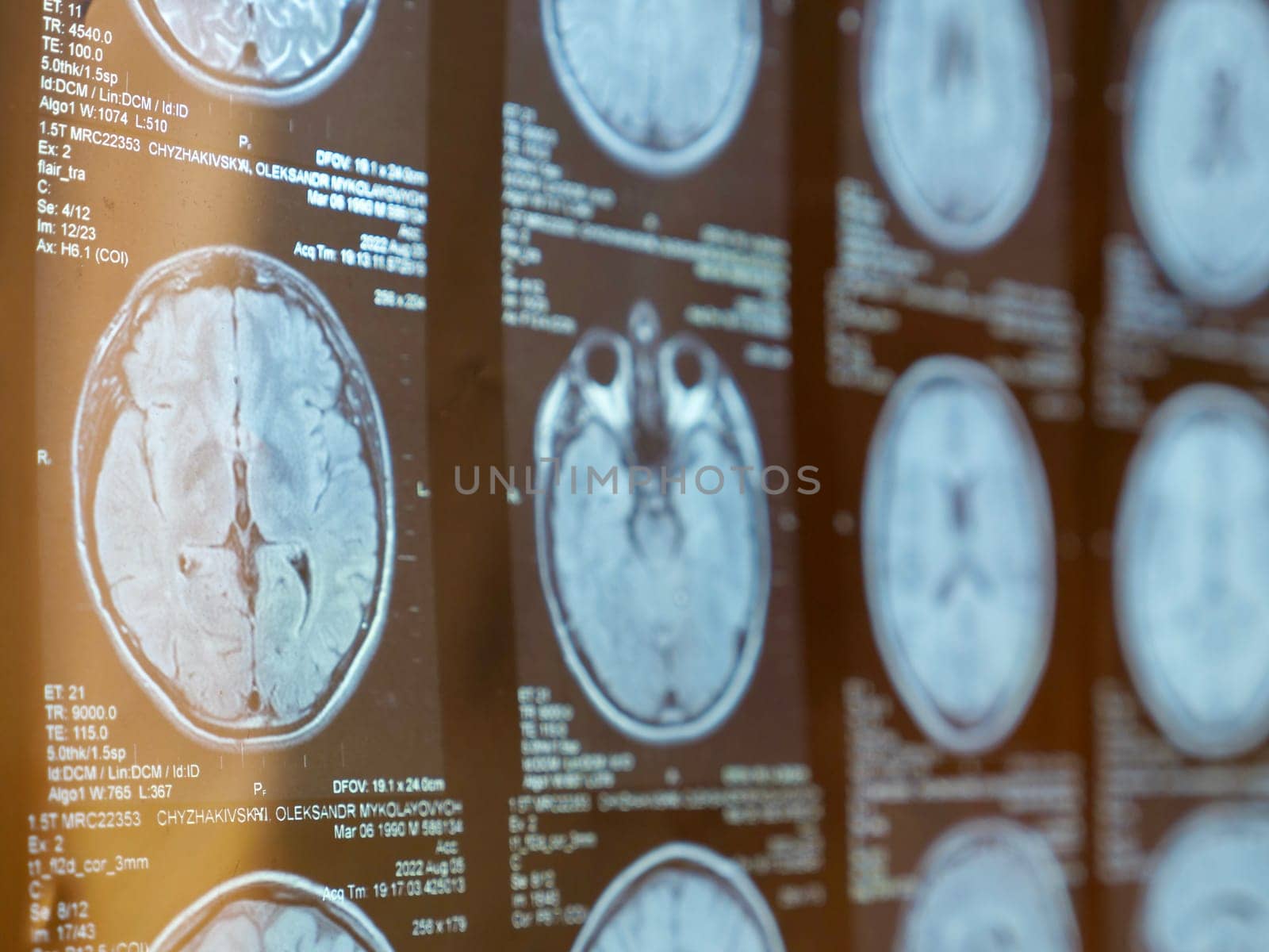 MRI of the human brain of a patient with multiple sclerosis of the initial stage. Close-up X-ray