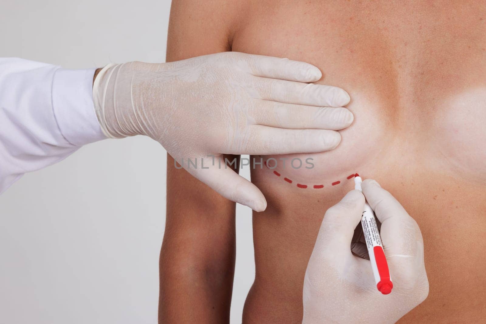 plastic surgeon drawing lines on female breast close up before mammoplasty surgery, breast augmentation and shape correction concept.
