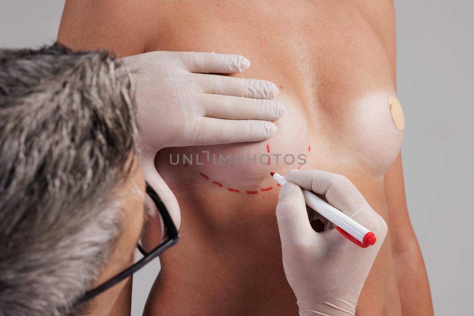 A plastic surgeon applies markings with a red marker before breast augmentation surgery, mammoplasty, concept beautiful breast shape