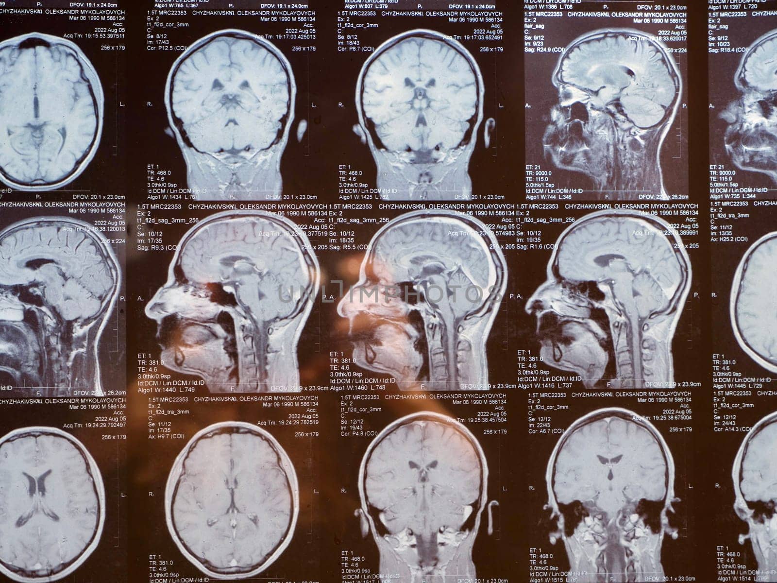 MRI of the human brain of a patient with multiple sclerosis of the initial stage. Close-up X-ray